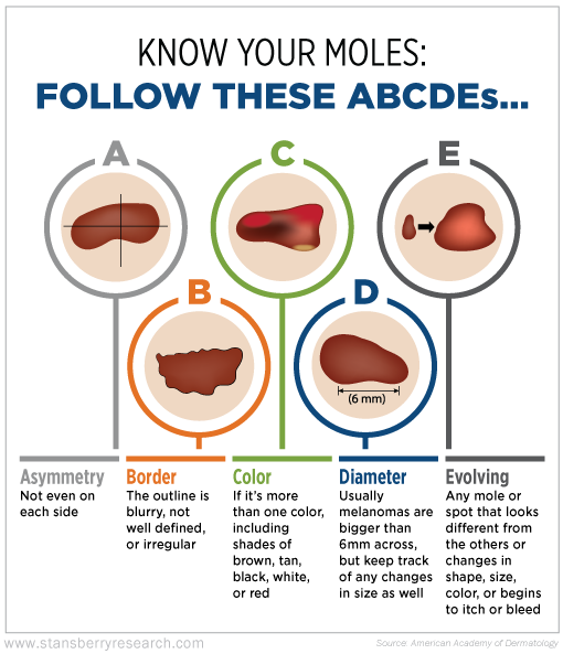 020117-RMD-Know-Your-Moles-Follow-These-ABCDE